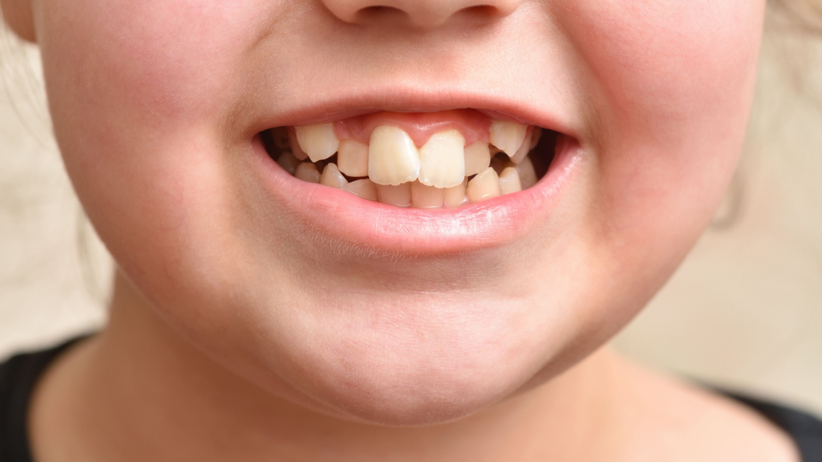 Crooked Teeth